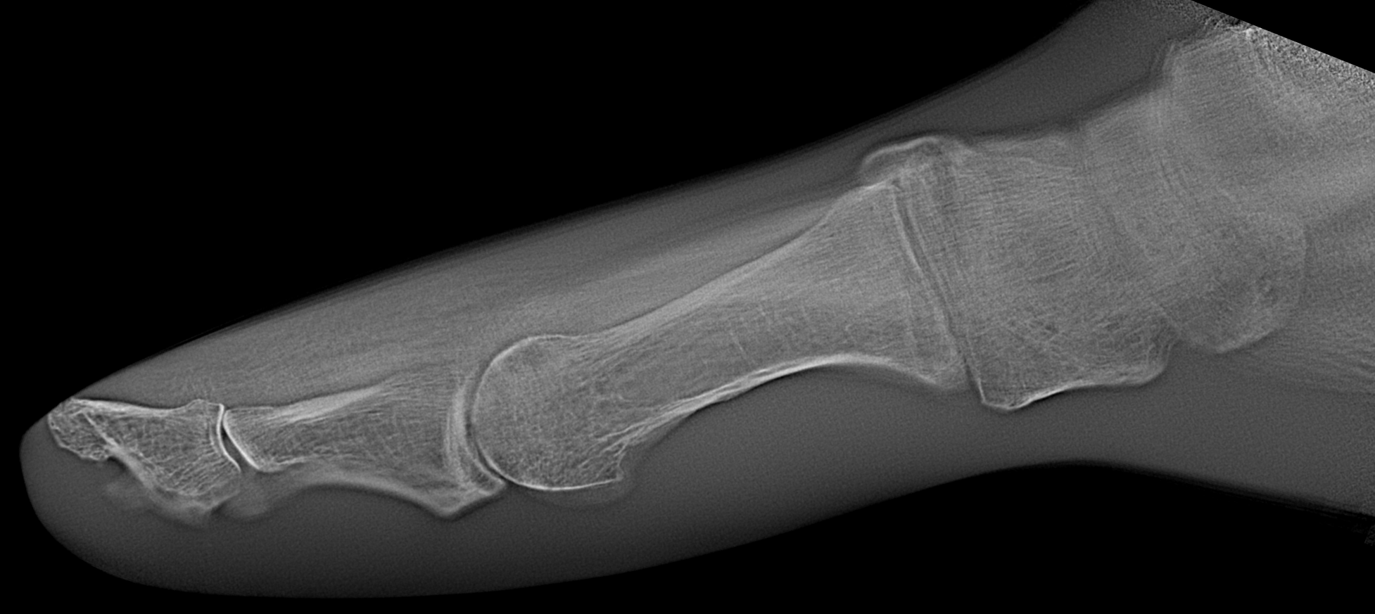 X-ray image of a foot
